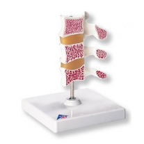 Modelo de osteoporosis - Versión de Lujo (3 Vertebrales)
