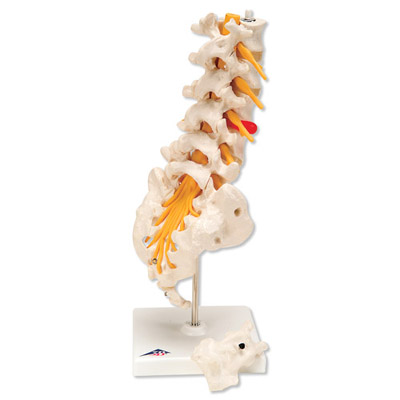 Columna vertebral lumbar con hernia discal dorsolateral