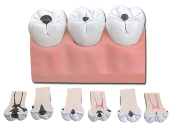 Caries dentales, 7 partes