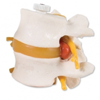Discos lumbares, con hernia discal. Montados de forma flexible sobre soporte