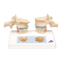 Modelo de osteoporosis | ENFERMEDADES DE LA COLUMNA VERTEBRAL