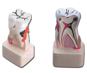 Modelo de patología dental