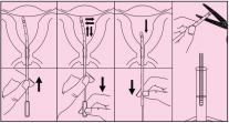 Cánula biopsia endometrial, 1 orificio, un solo uso